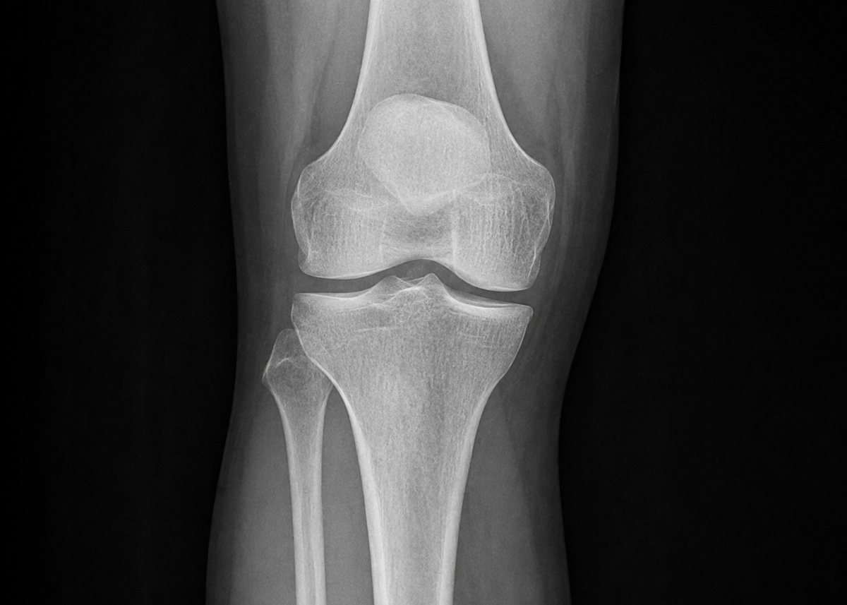 무릎 관절 X-ray